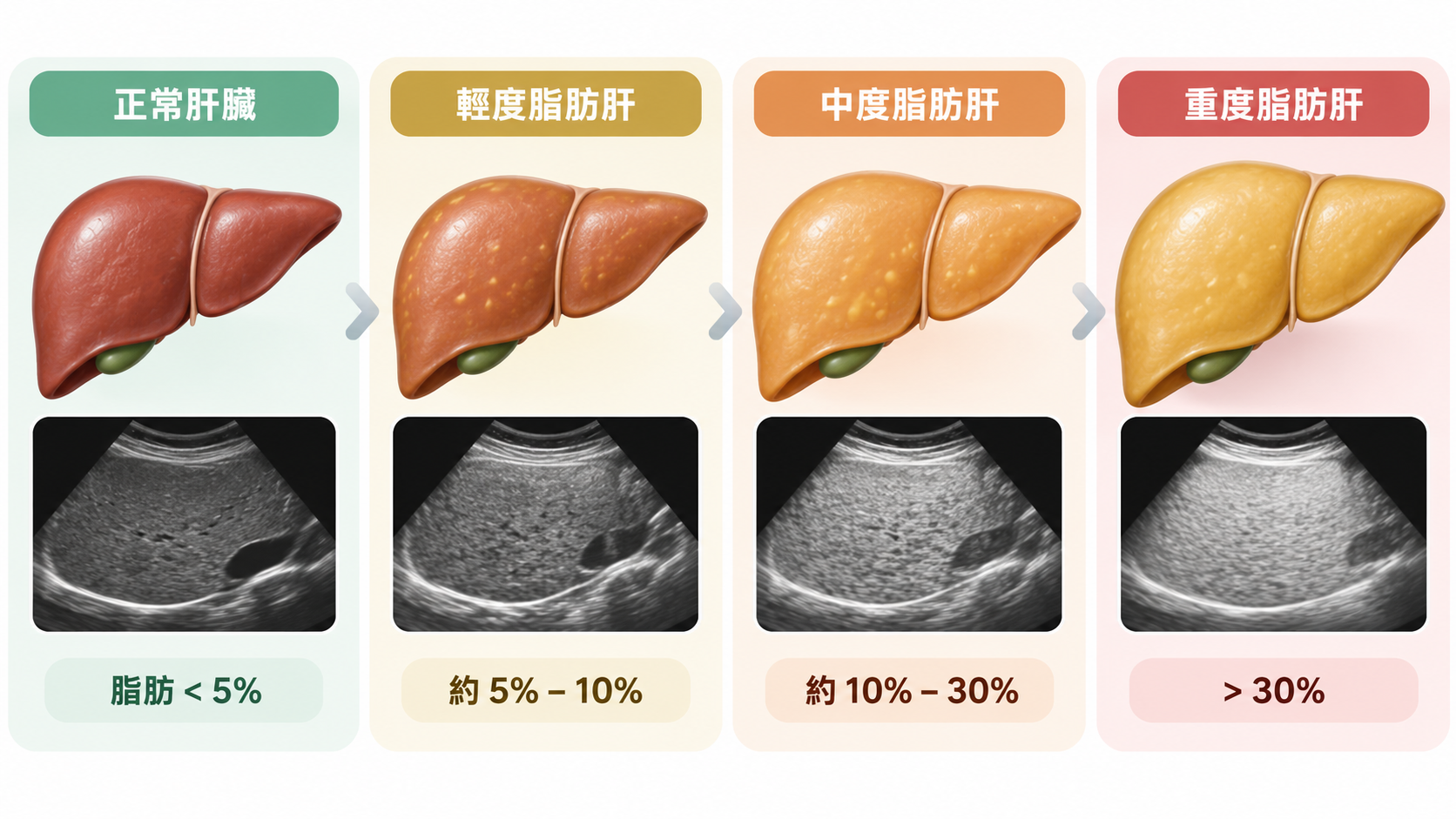 脂肪肝四階段超音波對照圖